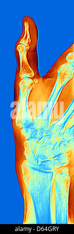 Arthrosis of the hand, X-ray Stock Photo