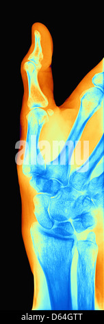 Arthrosis of the hand, X-ray Stock Photo