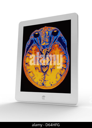 Computer showing a magnetic resonance imaging (MRI) scan of a human ...