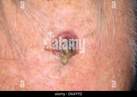 Skin cancer Stock Photo