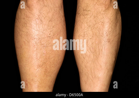 Deep vein thrombosis Stock Photo