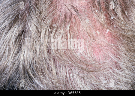 Dandruff in a gray hair of the growing bald elderly man concept macro. Selectice focus Stock Photo