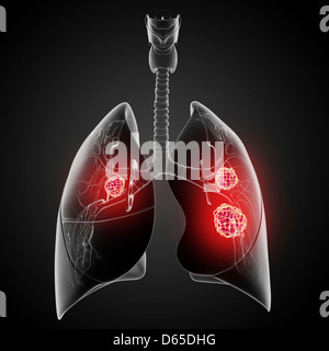 Lung cancer, artwork Stock Photo