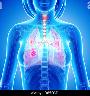 Female lung cancer, artwork Stock Photo