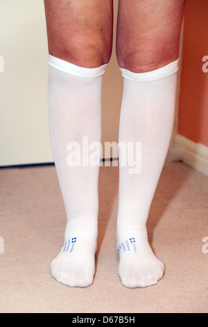 Deep vein thrombosis stockings hi-res stock photography and images