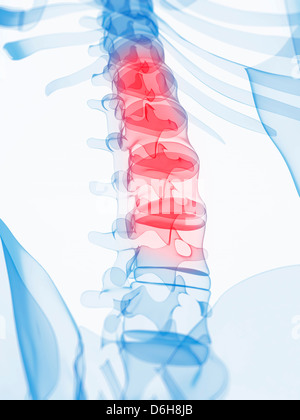 Back pain, conceptual artwork Stock Photo