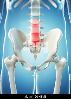 Back pain, conceptual artwork Stock Photo