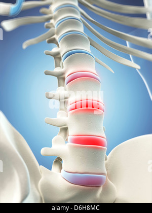 Back pain, conceptual artwork