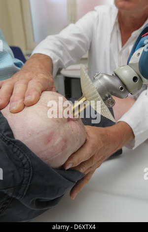 Luebeck, Germany, patients with Endo-Exo Prosthesis Stock Photo