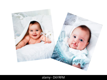 Pictures in a photo album of a baby who had surgery for a cleft lip. Stock Photo