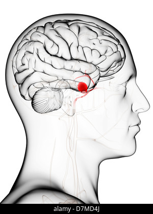 Brain aneurysm, artwork Stock Photo