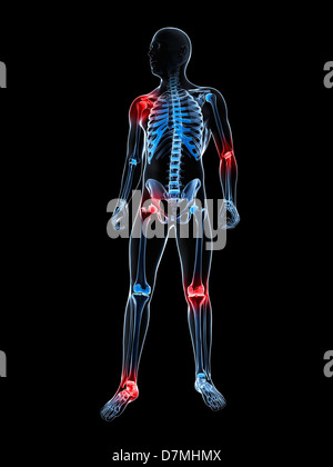 Joint pain, conceptual artwork Stock Photo