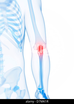 Elbow pain, conceptual artwork Stock Photo