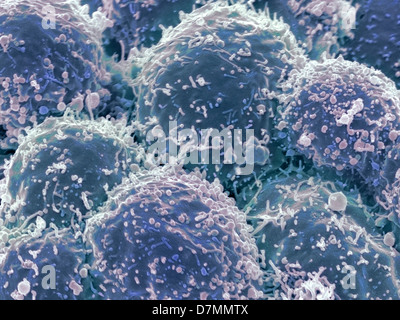 Lung cancer cells, SEM Stock Photo