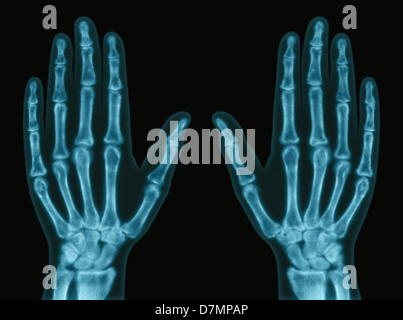 Hands, X-ray Stock Photo
