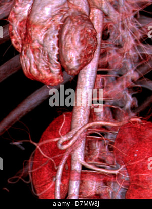 Abdominal aorta, 3D CT scan Stock Photo