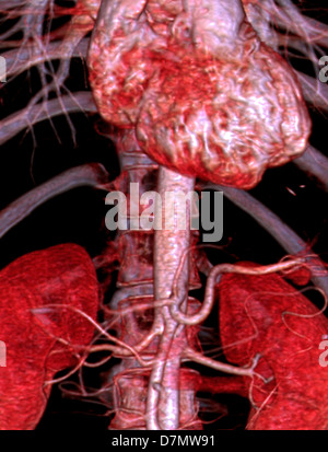 Abdominal aorta, 3D CT scan Stock Photo