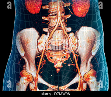 Abdominal aorta, 3D CT scan Stock Photo