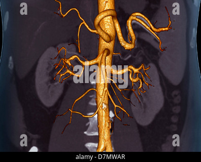 Abdominal aorta, 3D CT scan Stock Photo