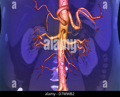 Abdominal aorta, 3D CT scan Stock Photo