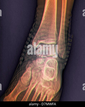 Healthy Ankle Joint X Ray Stock Photo Alamy