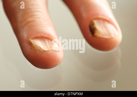 Nail fungus Stock Photo