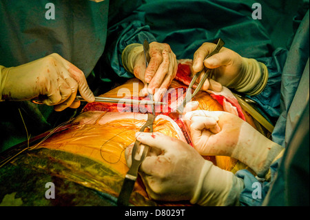 Surgeons performing a liver transplant. Stock Photo