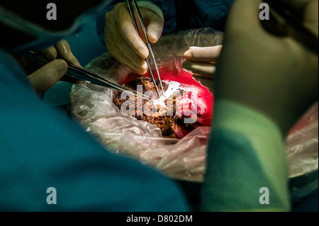 Surgeons performing a liver transplant. Stock Photo