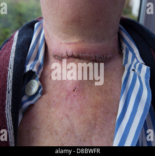 Man's neck showing thyroidectomy incision, with surgical clip closure. some post-operative bruising. Front view Stock Photo