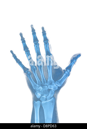 X Ray of human hand with broken wrist, fracture of radius, xray Stock ...