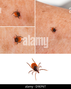 Tick on human skin and one isolated on white - Ixodida Stock Photo