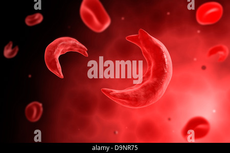 Microscopic view of sicke cells causing anemia disease. Stock Photo