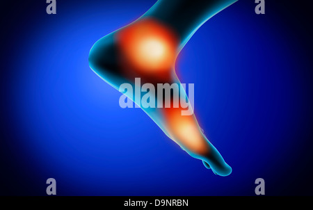 Conceptual image of muscle cramp and pain in human foot. Stock Photo