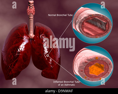 Trachea cross-section with lungs, showing comparison of normal and asthmatic bronchiole. Stock Photo