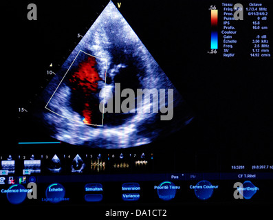 HEART, SONOGRAPHY RESULT Stock Photo