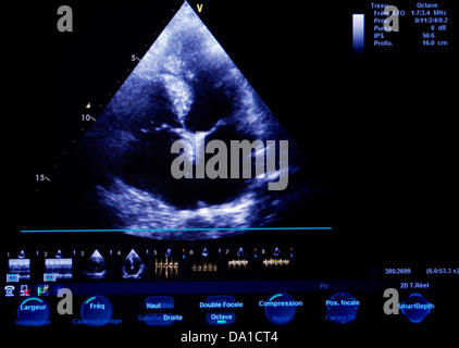 HEART, SONOGRAPHY RESULT Stock Photo