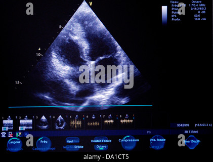 HEART, SONOGRAPHY RESULT Stock Photo