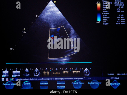 HEART, SONOGRAPHY RESULT Stock Photo