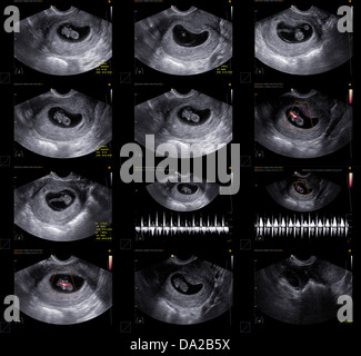 Obstetrical embryo ultrasound via transvaginal approach Stock Photo