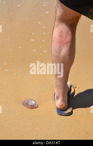 Jelly fish sting on Riviera beach, Ghajn Tuffieha, Malta. Stock Photo