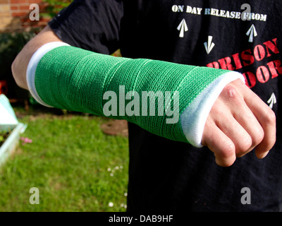 Solid cast after a fractured wrist, UK 2013 Stock Photo