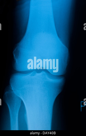 Authentic x-ray of male right knee Stock Photo