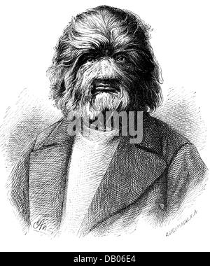 medicine, diseases, Hypertrichosis, portrait of Adrian Jefitchew, wood engraving after drawing by Adolf Neumann, circa 1880, Additional-Rights-Clearences-Not Available Stock Photo