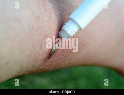 Treatment for insect bite or sting Stock Photo