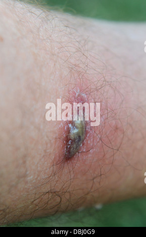 Insect bite or sting on human leg Stock Photo