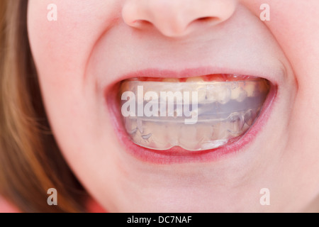 correction of children occlusion by pre-orthodontic trainer Stock Photo