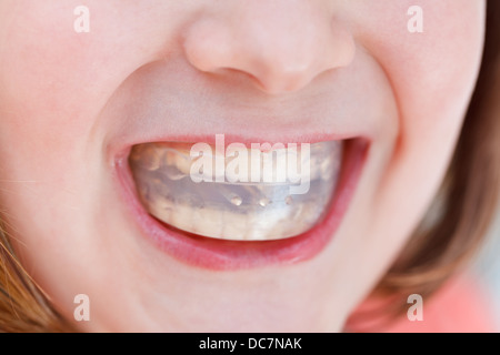 correction of child occlusion by orthodontic trainer Stock Photo