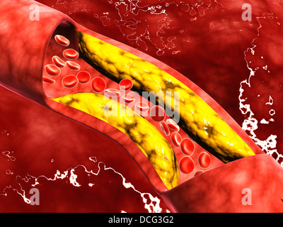 Microscopic view of fat plaque inside the artery. Stock Photo