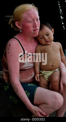 An albino Kuna woman with skin cancer cradles her young son. Stock Photo