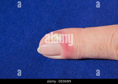 Bacterial infection, inflammation, index finger, pus, abscess Stock Photo